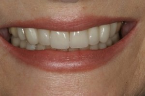 after cosmetic dentistry