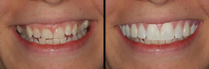 Cosmetic Dentistry Before & After