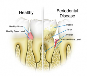 gum disease treatment in Philadelphia PA