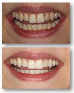Teeth whitening before and after for Aubrey