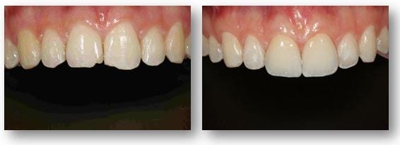 Porcelain veneers for chipped teeth