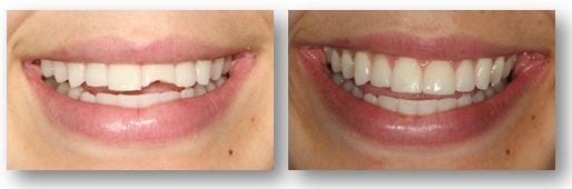 Before and after porcelain veneers in Philadelphia