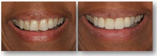 Before and after porcelain veneers in Philadelphia