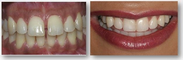 Invisalign results in Philadelphia PA