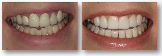 Invisalign and dental crowns before and after