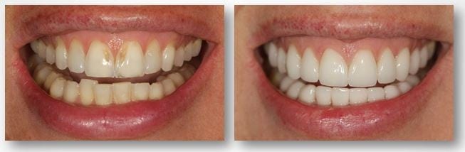 Before and after tooth enamel erosion treatment