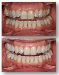 Jean deep bleaching teeth whitening results