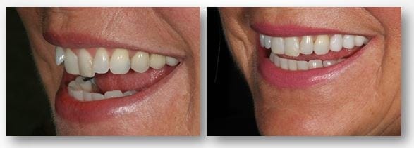 Jean before and after Invisalign