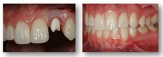 Jennifer before and after replacing old dental implant in Philadelphia PA