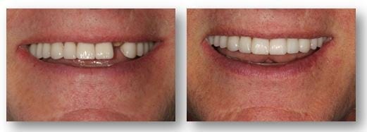 Kent Dental Implants before and after visiting our implant dentistry