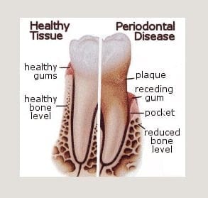 Symptoms of gum disease in Philadelphia PA