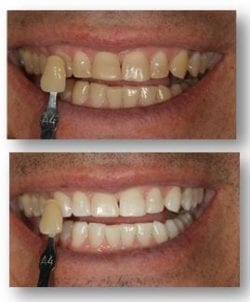 Deep teeth bleaching in Philadelphia PA