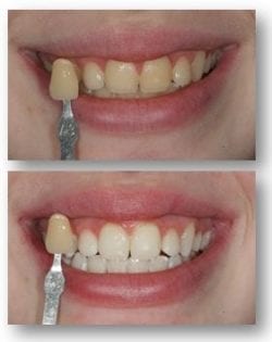 Sophy Invisalign results in Philadelphia PA