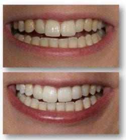 Take-home teeth whitening before and after in Philadelphia PA
