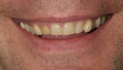 Before teeth grinding treatment in Philadelphia PA