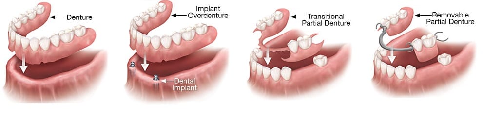 dentures in Philadelphia, PA