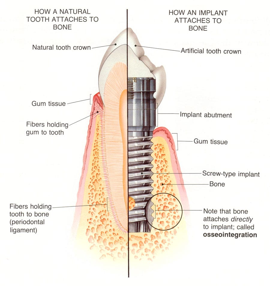 dental implant process philadelphia pa