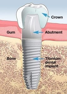 Diagram of a dental implant