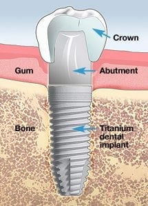 Diagram of a dental implant