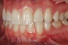 Jennifer after replacing old dental implant in Philadelphia PA