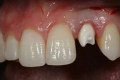 Jennifer before replacing old dental implant in Philadelphia PA