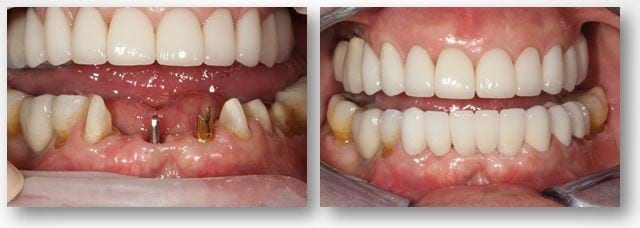 implant-supported dental bridge in Philadelphia, PA