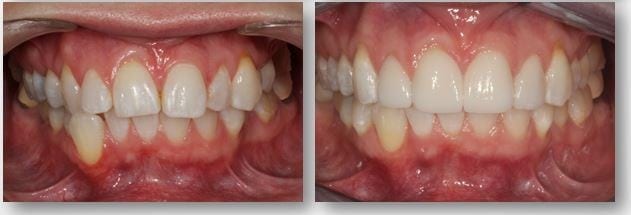 before and after porcelain veneers