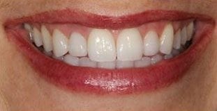 Sarah Dental Implants After