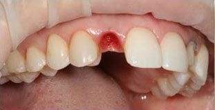 Sarah Dental Implants Before