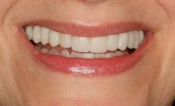 After Smile Makeover