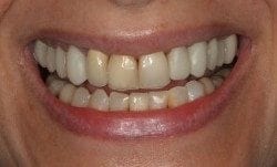 smile-makeover-before