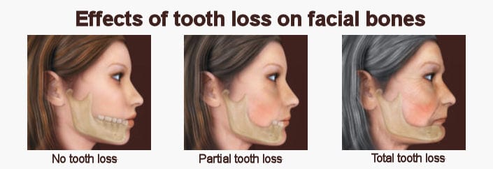 Effects of tooth loss on facial bones