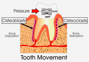 speeding tooth movement in orthodontics philadelphia pa