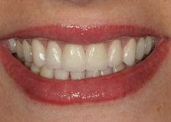 after porcelain veneers