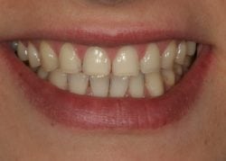 before porcelain veneers