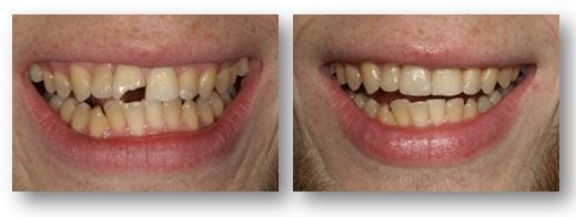 Dental bonding for chipped teeth before and after