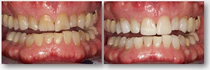 interim dental bonding before and after