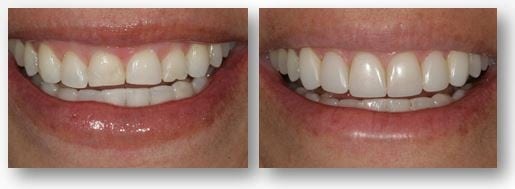 Dental bonding for worn teeth before and after
