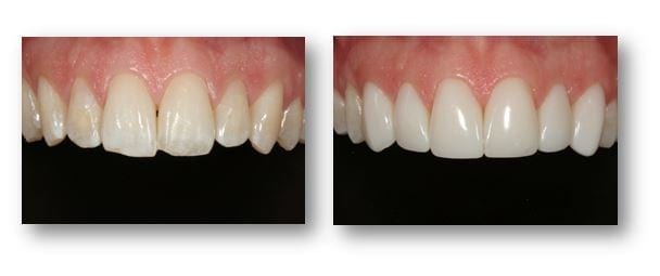 Before and after cosmetic tooth bonding