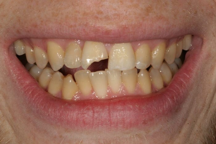 tooth bonding for chipped tooth by Philadelphia dentist Pamela Doray