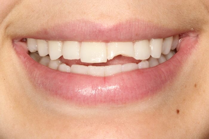 tooth bonding for chipped tooth by Philadelphia dentist Pamela Doray