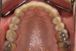 Bill upper arch after bite correction procedure