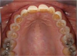 Bill upper arch before bite correction procedure