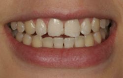 Ava before porcelain veneers for chipped teeth in Philadelphia PA