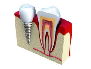 Single dental implant in Philadelphia