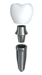 affordable dental implants with Dr. Doray