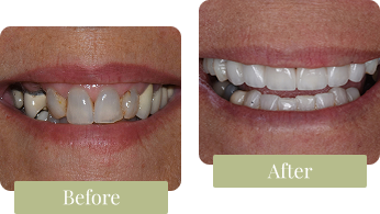 Dental Veneers