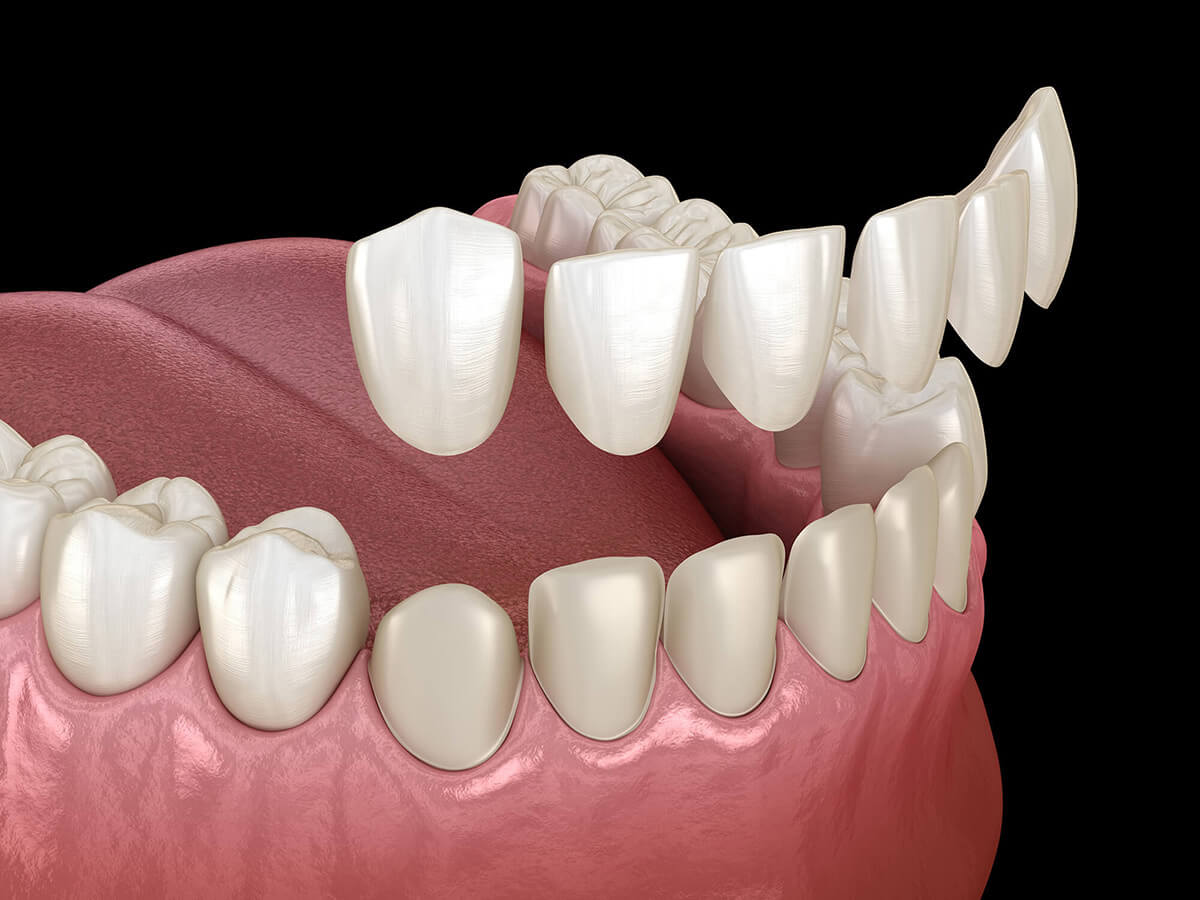 Dental Veneers in Philadelphia, PA at Opus Dental Esthetics