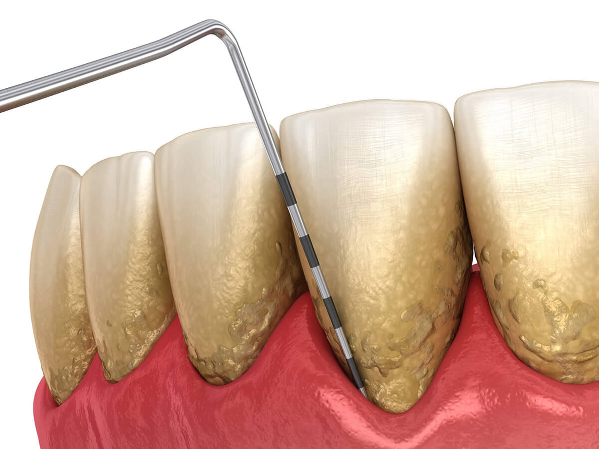 Periodontal Therapy