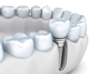 implant dentistry boosts jaw health